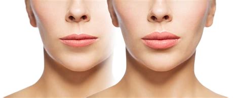 Lip Enhancement You Can Have Fuller Natural Looking Lips