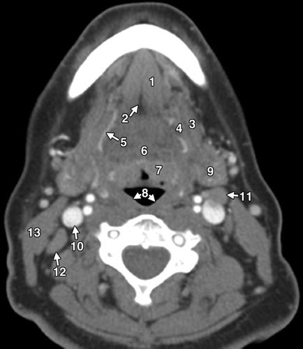 Cancers Of The Oral Cavity And Oropharynx Fdg Pet With Contrast