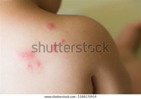 Skin Rash Blisters On Body Stock Photo Edit Now 1188170959