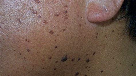Dermatosis Papulosa Nigra መልክ መንስኤዎች እና መወገድ የሰውነትዎ ጤና