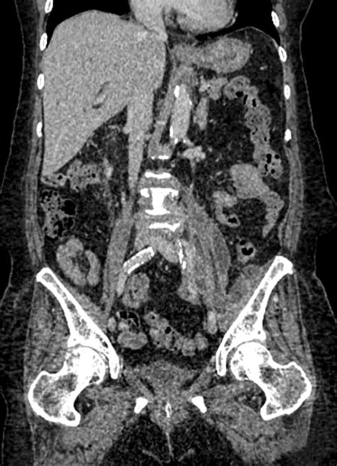 Abdomen Pelvis Computed Tomography Images Show Multi Lobulated Psoas