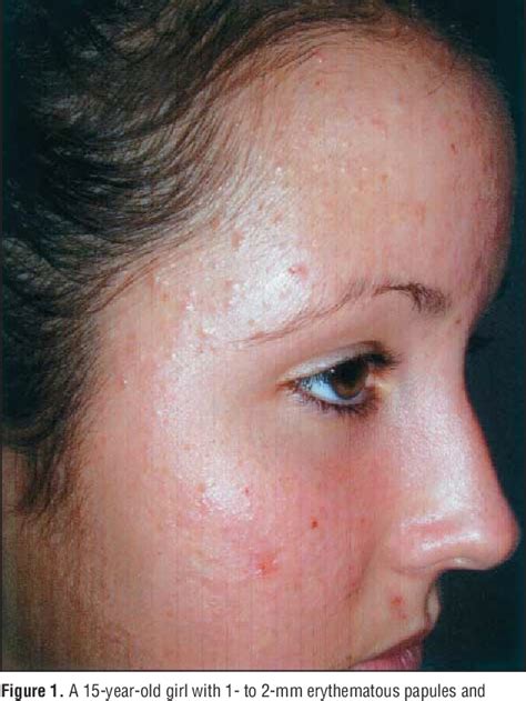 Figure 1 From Pityrosporum Folliculitis Diagnosis And Management In 6
