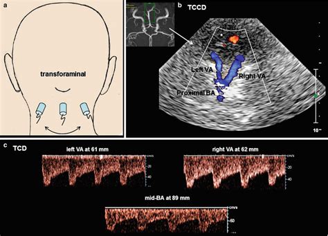 Transcranial Doppler Sonography Thoracic Key