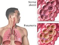 Nursing Care Plans For Pneumonia Hot Sex Picture