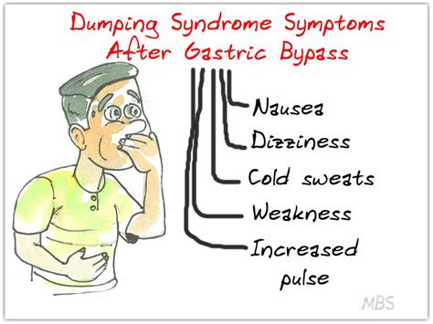 What Is Gastric Bypass Dumping Syndrome Gastric Bypass Gal Gambaran