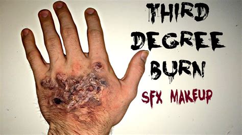 Third Degree Burn Skin Sfx Makeup Youtube