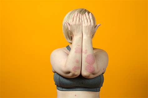 Malattia Dermatologica Della Pelle Psoriasi Eczema Dermatite Allergie
