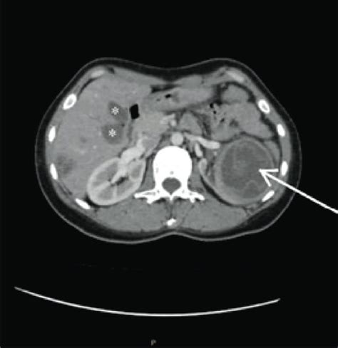 Abdominal Ct Scan Of The Patient Showing A Multiple Cysts In The