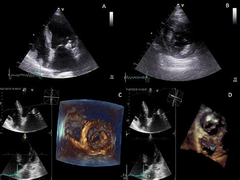 Caseous Calcification Of The Mitral Annulus Presenting As Recurrent