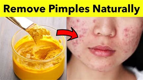 How To Get Rid Of Pimples Fast Home Remedy To Remove Pimples