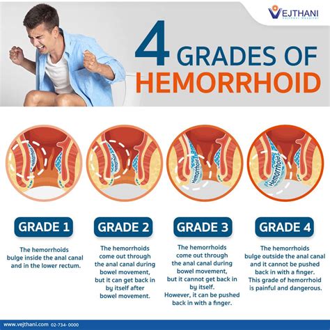 When To Go To The Hospital For Hemorrhoids