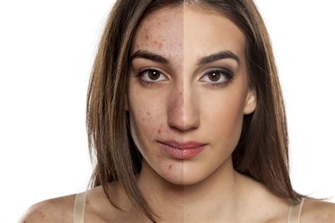 Top Ways To Prevent And Treat Acne Scars Blog