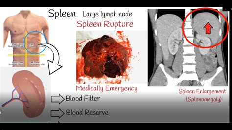 Spleen Pain Spleen Enlargement And Spleen Rupture Causes And