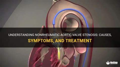 Understanding Nonrheumatic Aortic Valve Stenosis Causes Symptoms And