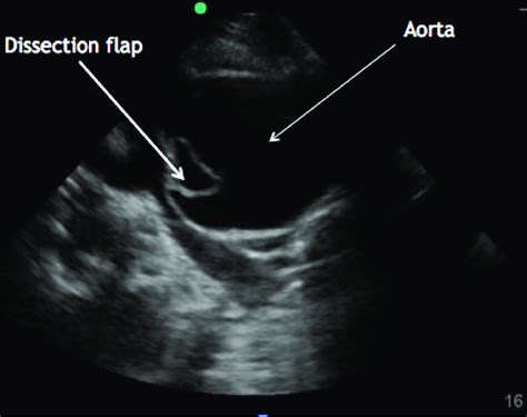 Transhoracic Echo Parasternal Long Axis View Showing Dilated Aortic