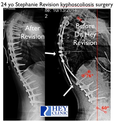 Dr Lloyd Heys Blog Scoliosis And Spine Care Aviation Safety And Quality Standard Work