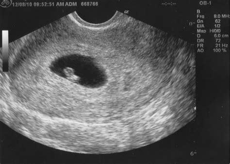 Ultrasound 6 Weeks Pregnant With Twins Symptoms