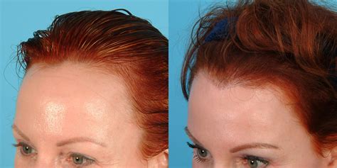 Benefits And Expectations Of Hairline Lowering Surgery Mymeditravel