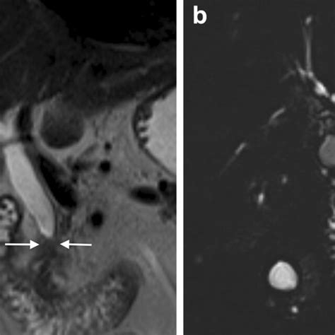 Cholangiocarcinoma On T2 Weighted Mri A And Mrcp B Findings
