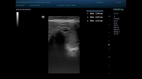 Multinodular Thyroid Goiter Mng Ultrasound Case Youtube