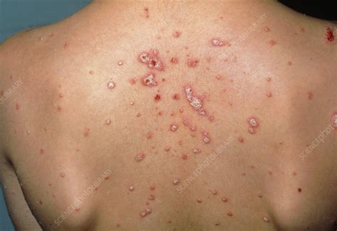 Acute Plaque Psoriasis Stock Image M2400169 Science Photo Library
