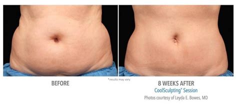 Coolsculpting Elite Before And After New Treatment With Better Results