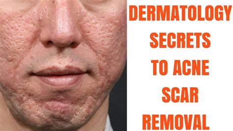 Acne Scars Removal