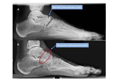 Talonavicular Arthitis Arthritis Of The Talonavicular Joint