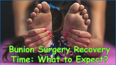 Bunion Surgery Recovery Time Week By Week