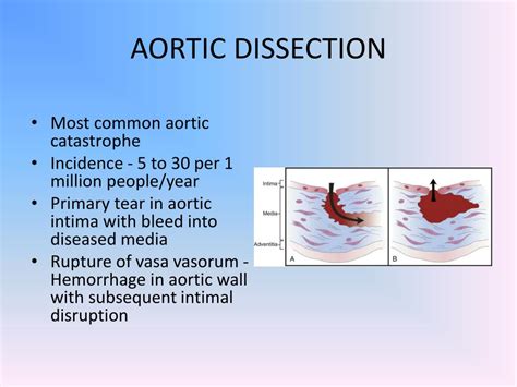 Ppt Acute Aortic Syndromes Powerpoint Presentation Free Download