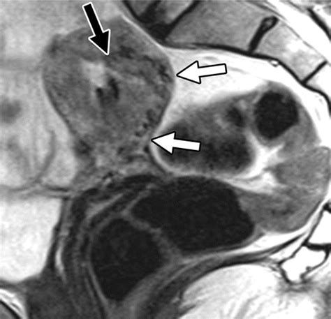 A Pictorial Review Of Postpartum Complications Radiographics