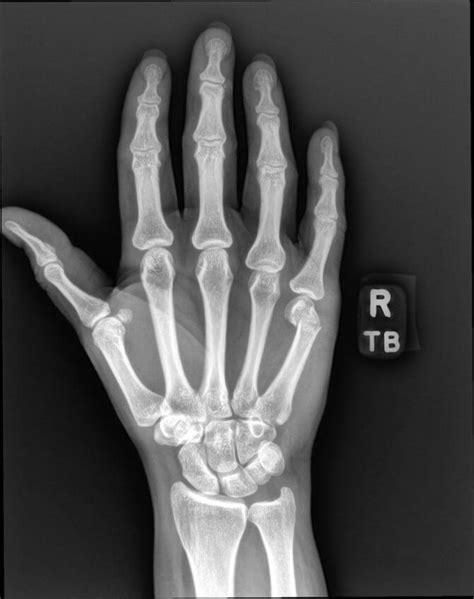 Orthodx Finger Injury From Punch Impact Clinical Advisor