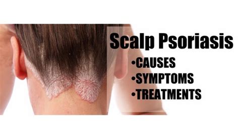 Psoriasis Scalp Types