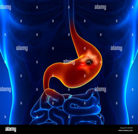 Stomach Ulcer Endoscopy Hi Res Stock Photography And Images Alamy