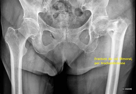 Ces cookies permettent d'obtenir des statistiques de fréquentation anonymes ainsi que des rapports d'erreur lors de la visite du site, afin d'optimiser son ergonomie, sa navigation et ses contenus. fracture du col femoral : osteosynthese et prothese de ...