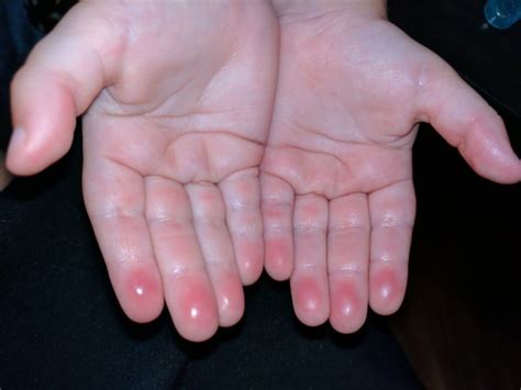 Red Spots On Fingertips