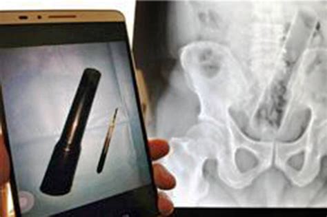 Man Refuses To Tell Docs How Inch Torch Became Lodged In Anus