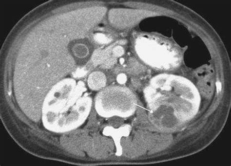 Dx Renal Abscess In A 67 Year Old Woman A And B Contrastenhanced