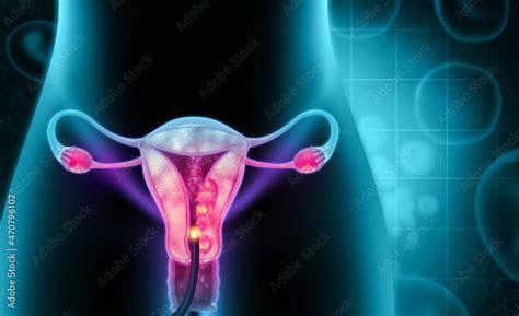 Dilation And Curettage D And C Endometrial Biopsy Cervical Cancer D