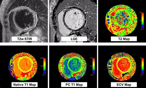 Journal of the american college of cardiology vol. Performance of T1 and T2 Mapping Cardiovascular Magnetic ...