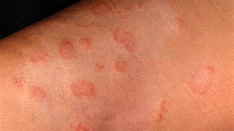Is Ringworm Skin Infection Caused By A Parasite Alergiay Alimentos