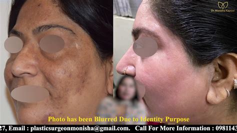 Most Effective Way Remove Acne Scar And Pigmentation Surgical