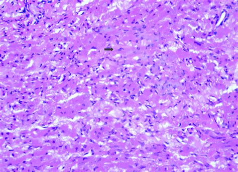 A Low Power Histologic Appearance Of The Tumor Large Polygonal Cells