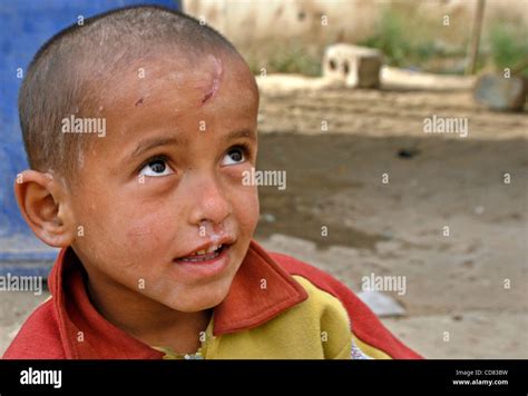 Shrapnel Scars Hi Res Stock Photography And Images Alamy