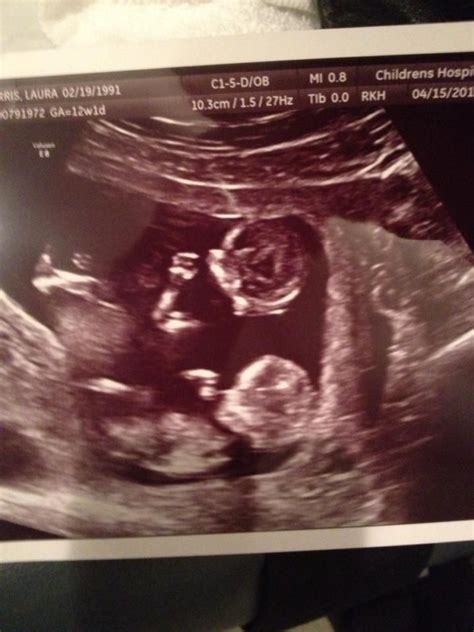 The sonographer will apply a gel on. My ultrasound of twins at 12 weeks! | Ultrassom, Dicas de ...