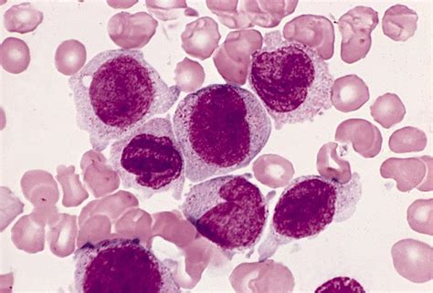 Pathology Outlines Monocytes