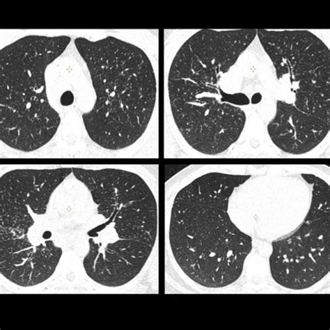 Stage Iv Pulmonary Sarcoidosis In A 54 Year Old Man Thoracic Axial Ct