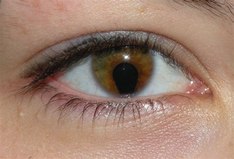 Filecoloboma Of The Iris Wikimedia Commons