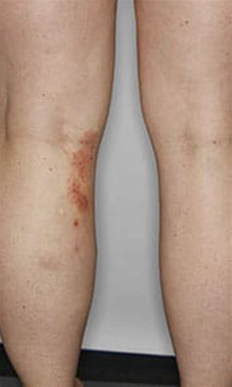 Itchy Legs Treatments Vein Clinic Perth
