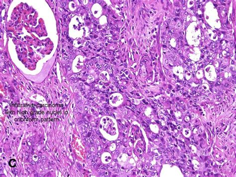 American Urological Association Renal Medullary Carcinoma